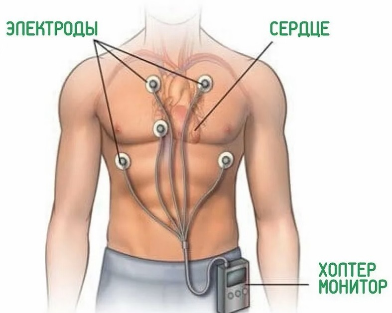 Установка холтера на сердце схема подключения